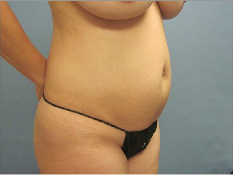 Before — 35-44 year old woman treated with Tummy Tuck