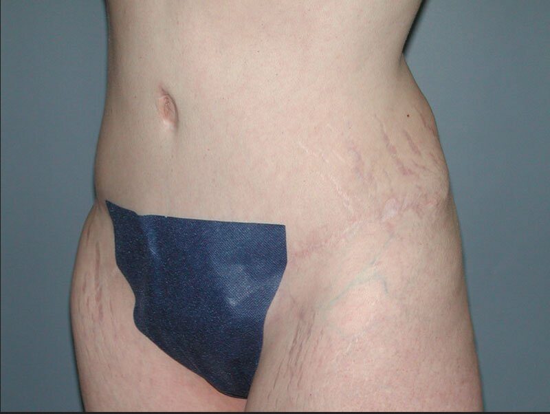After — 35-44 year old woman treated with Tummy Tuck