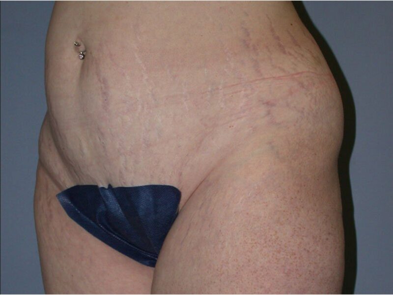 Before — 35-44 year old woman treated with Tummy Tuck