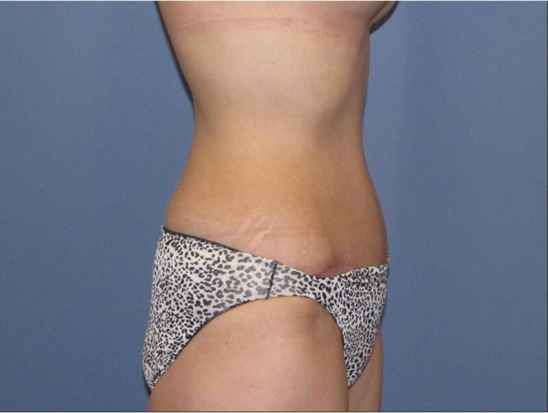After — 35-44 year old woman treated with Tummy Tuck