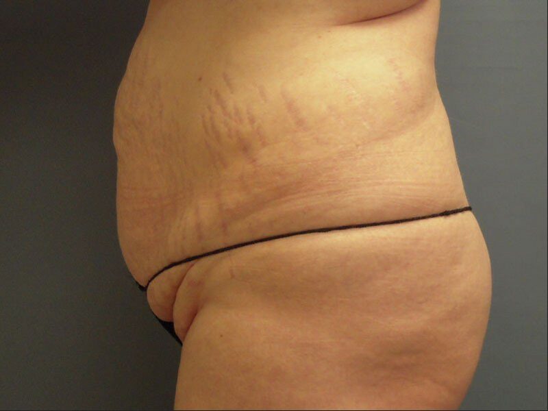 Before — 45-54 year old woman treated with Tummy Tuck