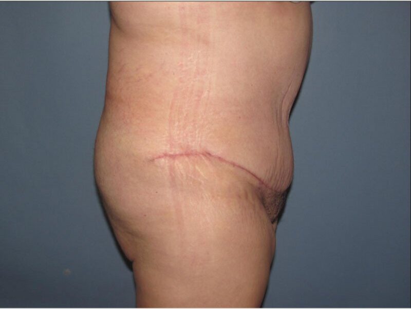 After — 35-44 year old woman treated with Tummy Tuck