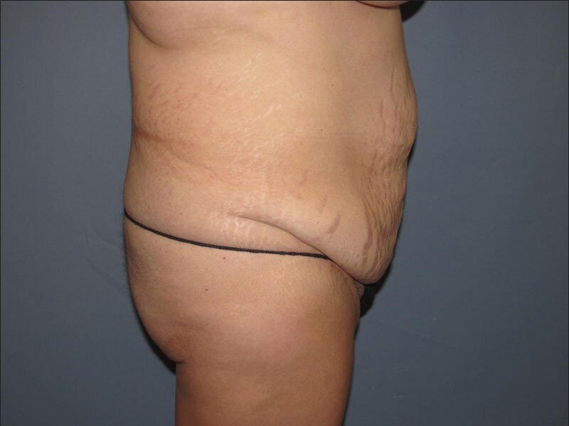Before — 35-44 year old woman treated with Tummy Tuck