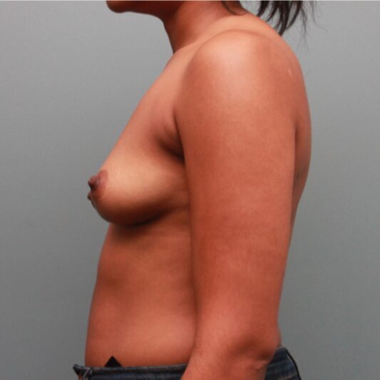 Before — 29 year old woman treated with Breast Augmentation