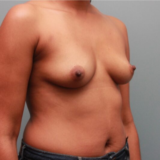 Before — 29 year old woman treated with Breast Augmentation