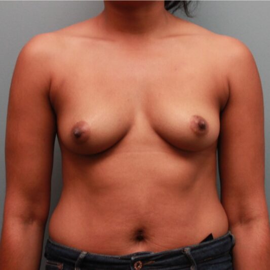 Before — 29 year old woman treated with Sientra Breast Implants