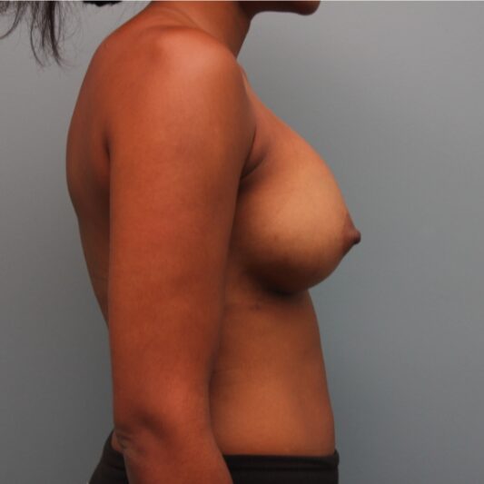 After — 29 year old woman treated with Breast Implants