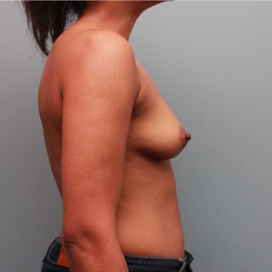 Before — 29 year old woman treated with Breast Implants