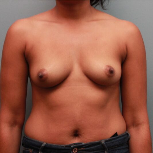 Before — 29 year old woman treated with Breast Implants