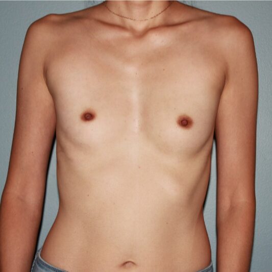 Before — 36 year old woman treated with Ideal Implants