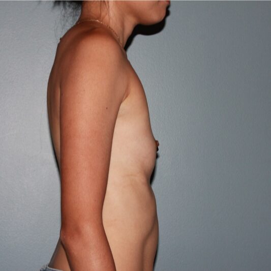Before — 36 year old woman treated with Ideal Implants