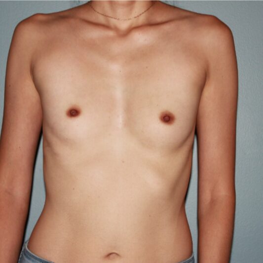 Before — 36 year old woman treated with Breast Implants