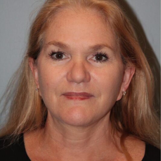 After — 57 year old woman treated with Lower Face Lift