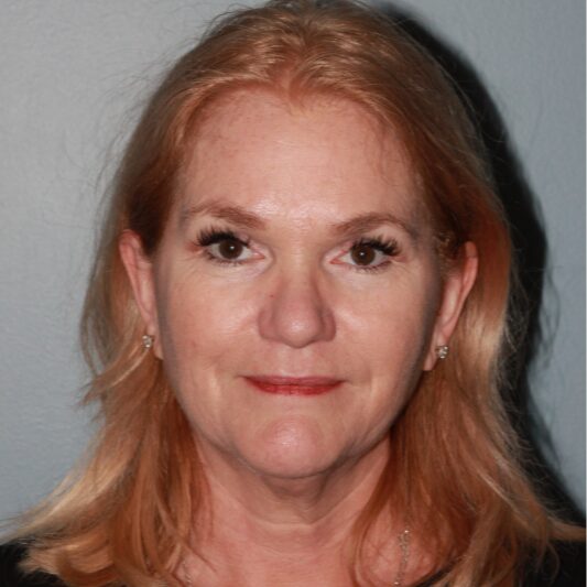 Before — 57 year old woman treated with Lower Face Lift