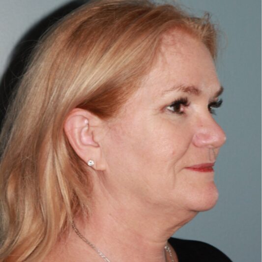 Before — 57 year old woman treated with Lower Face Lift