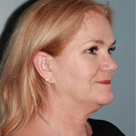 Before — 57 year old man treated with SMAS Facelift