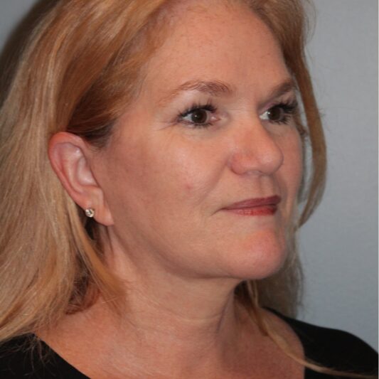 After — 57 year old woman treated with MACS Facelift