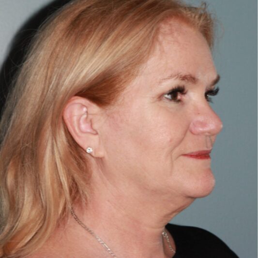 Before — 57 year old woman treated with MACS Facelift