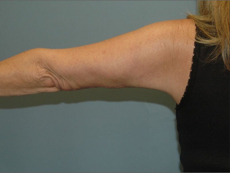 After — 55-64 year old woman treated with Arm Lift