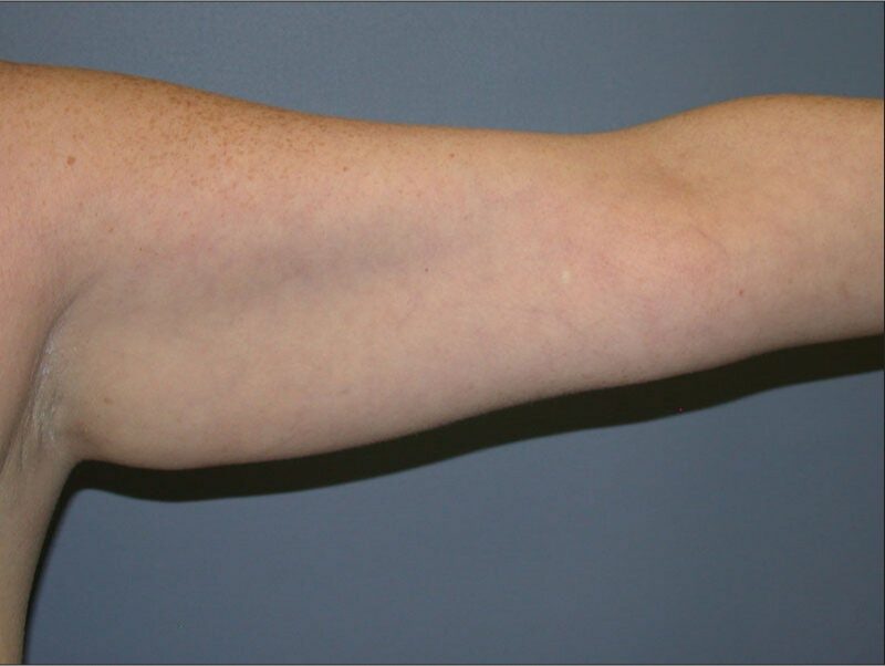 Before — Woman treated with Arm Lift