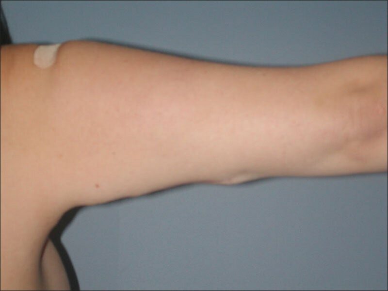After — 35-44 year old woman treated with Arm Lift
