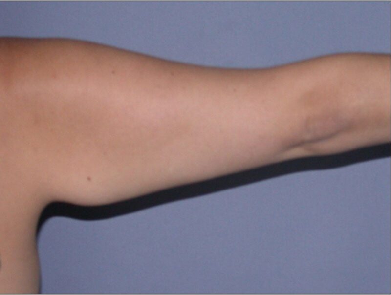 Before — 35-44 year old woman treated with Arm Lift