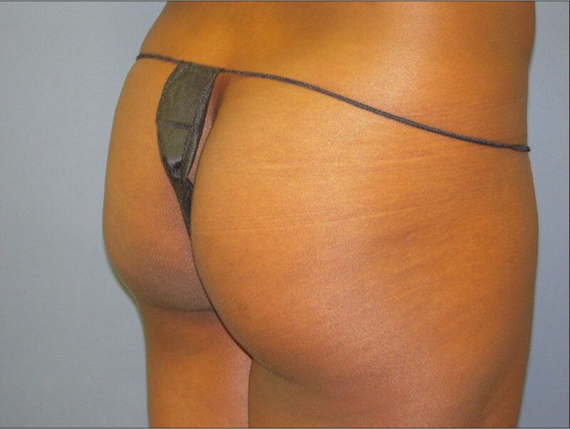 Before — 35-44 year old woman treated with Brazilian Butt Lift