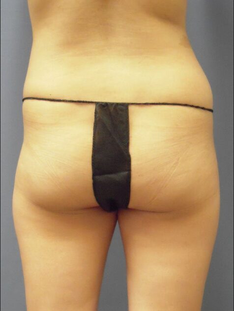Before — Woman treated with Brazilian Butt Lift