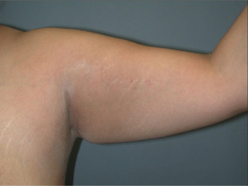 Before — Woman treated with Arm Lift