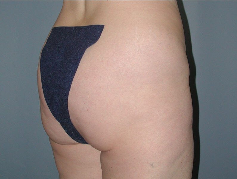 Before — 25-34 year old woman treated with Brazilian Butt Lift