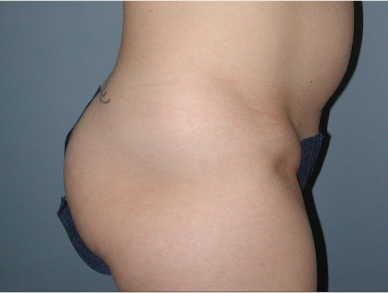 After — 35-44 year old woman treated with Brazilian Butt Lift