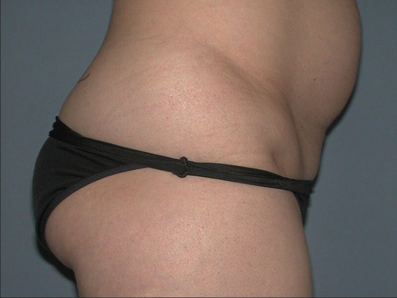 Before — 35-44 year old woman treated with Brazilian Butt Lift