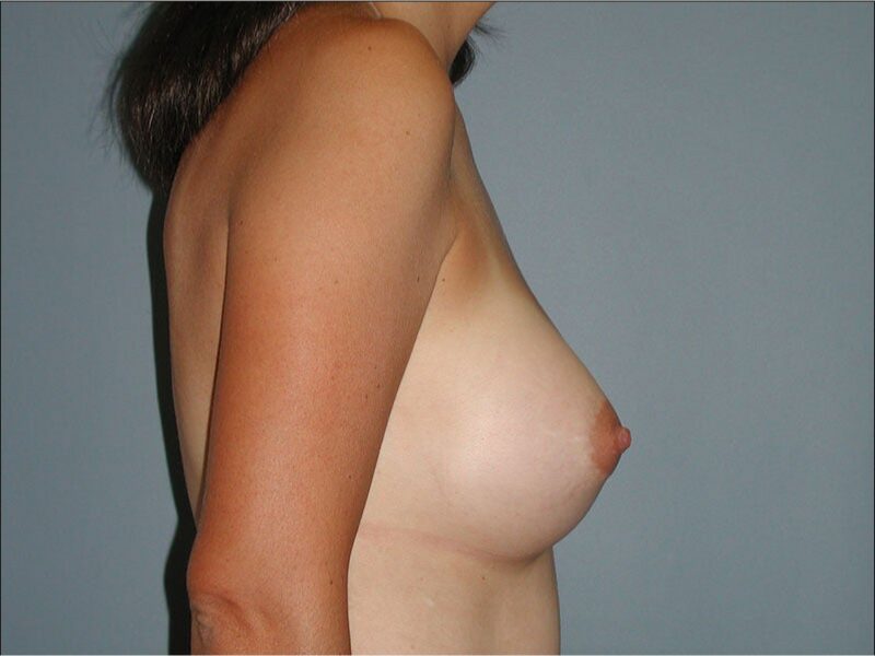 After — Woman treated with Breast Augmentation