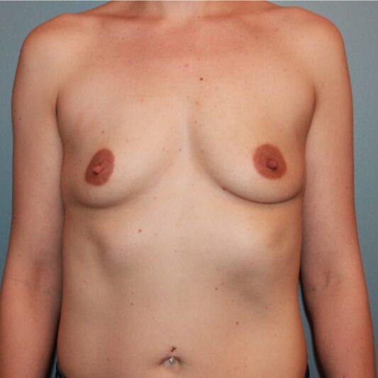 Before — 25-34 year old woman treated with Ideal Implant