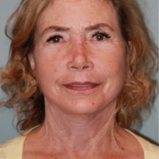 After — 75 and up year old woman treated with Facelift