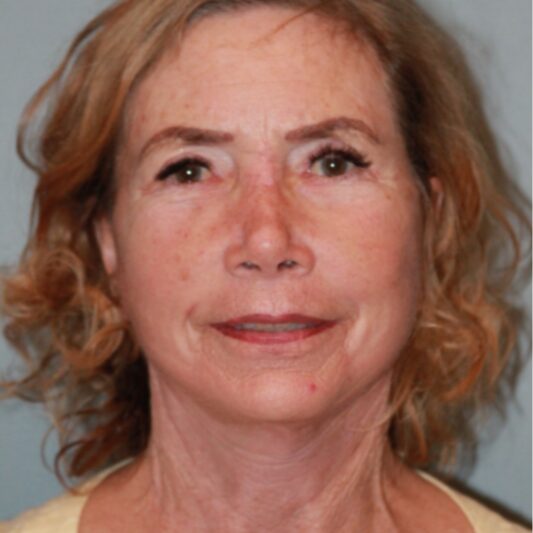 After — 75 and up year old woman treated with Lower Face Lift
