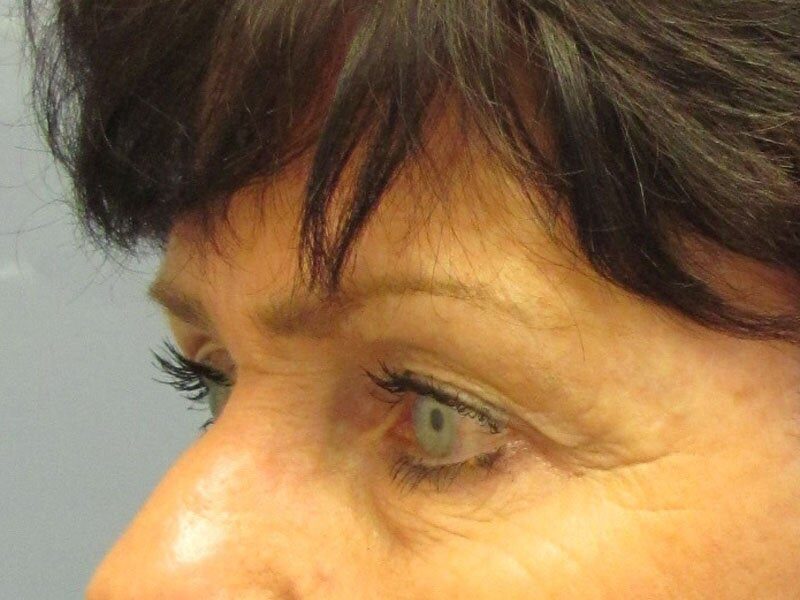 Before — Eyelid Surgery