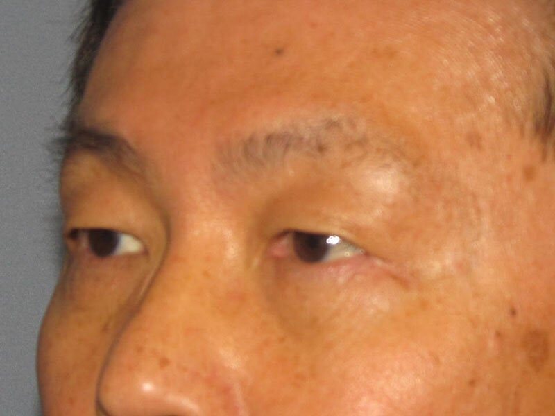 After — Eyelid Surgery