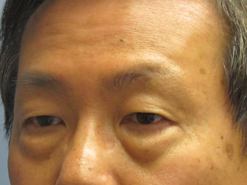 Before — Eyelid Surgery