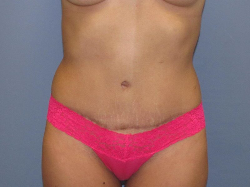 After — Tummy Tuck on 39-year-old