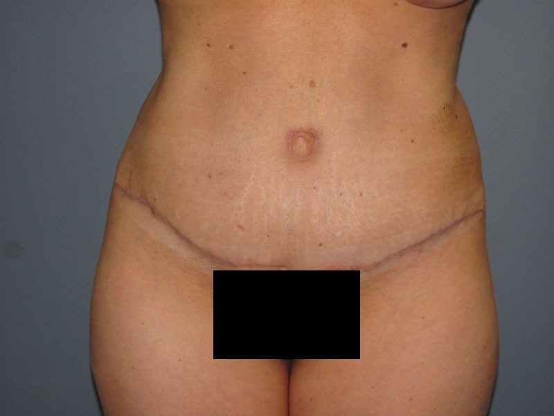 After — Tummy Tuck