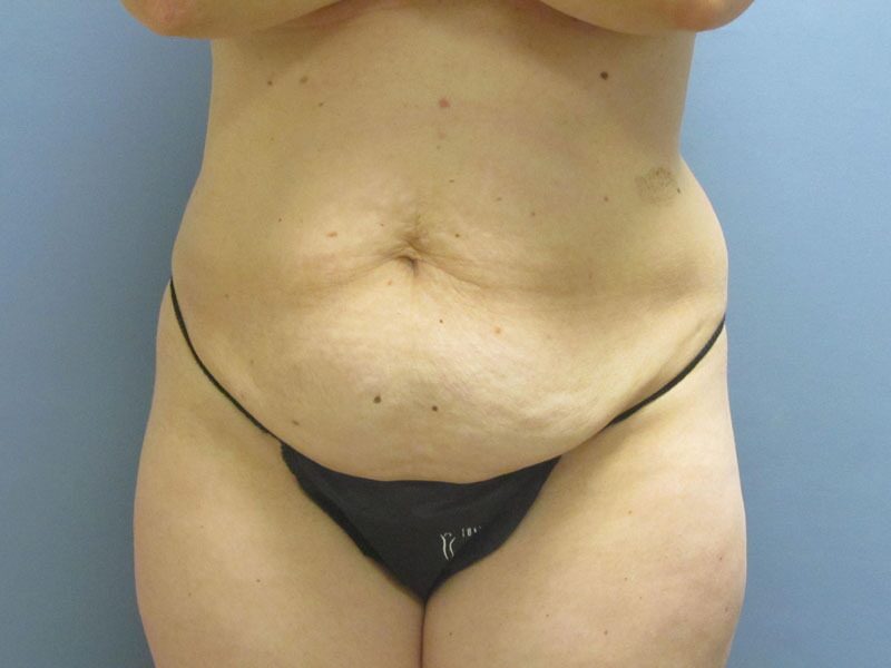 Before — Tummy Tuck