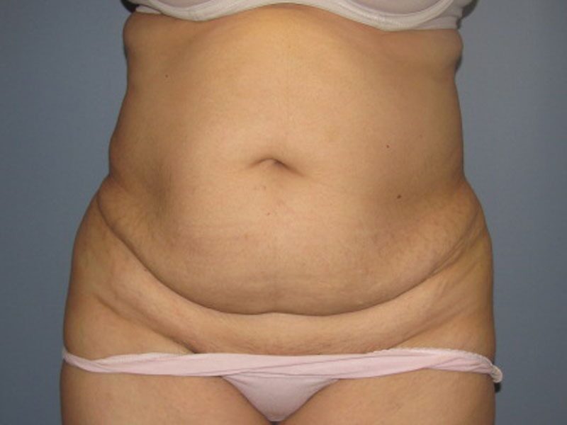 Before — Tummy Tuck