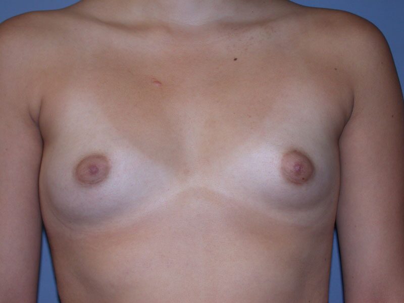 Before — Breast Augmentation