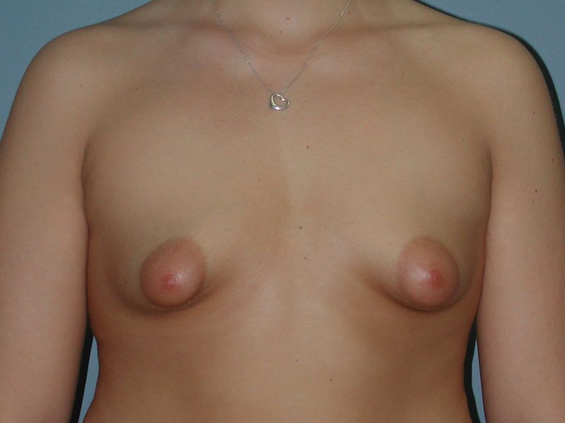 Before — Breast Augmentation on 23-year-old