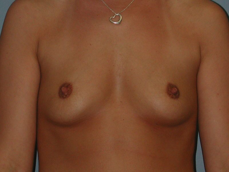 Before — Breast Augmentation