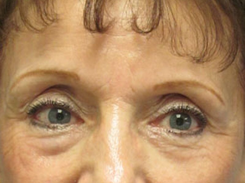 Before — Blepharoplasty