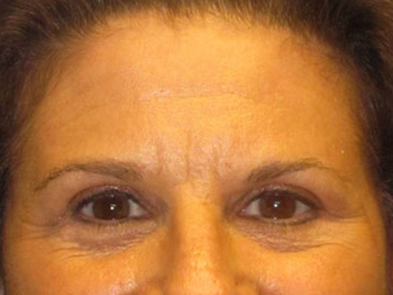 After — Blepharoplasty