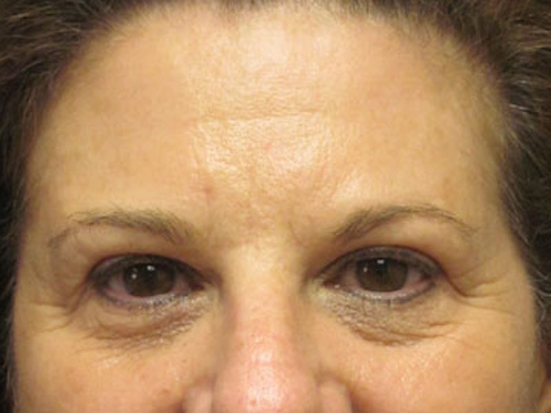 Before — Blepharoplasty