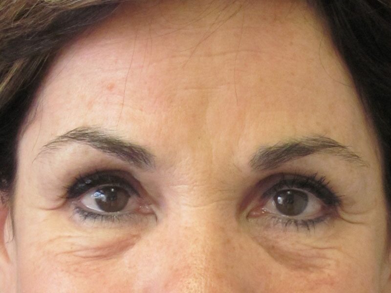 Before — Blepharoplasty